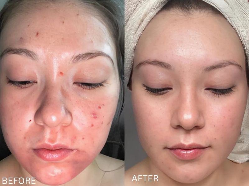 trước và sau khi sử dụng Inopharm 9% AHA+BHA Peeling Formula