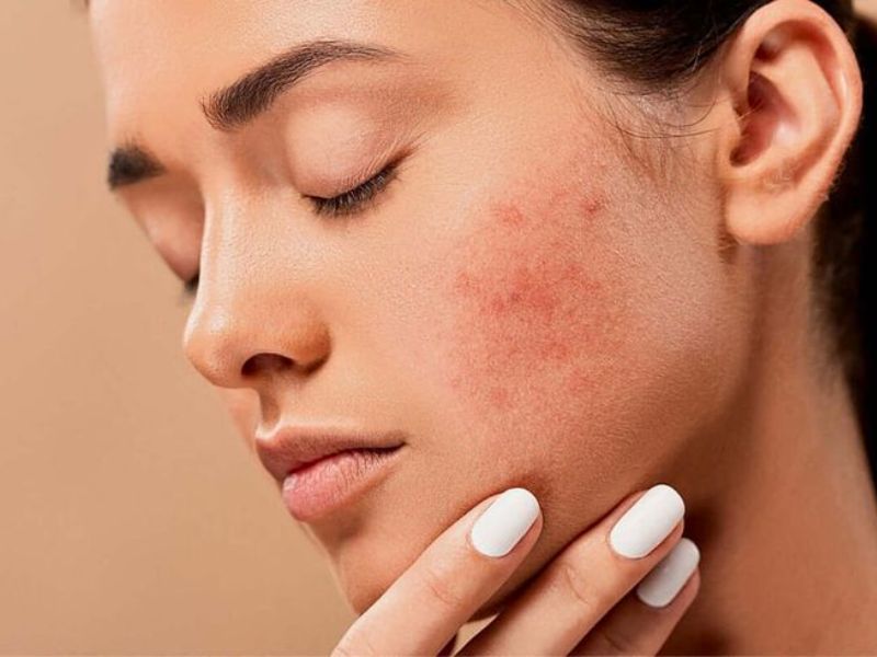 Không phải ai cũng dùng được AHA và BHA